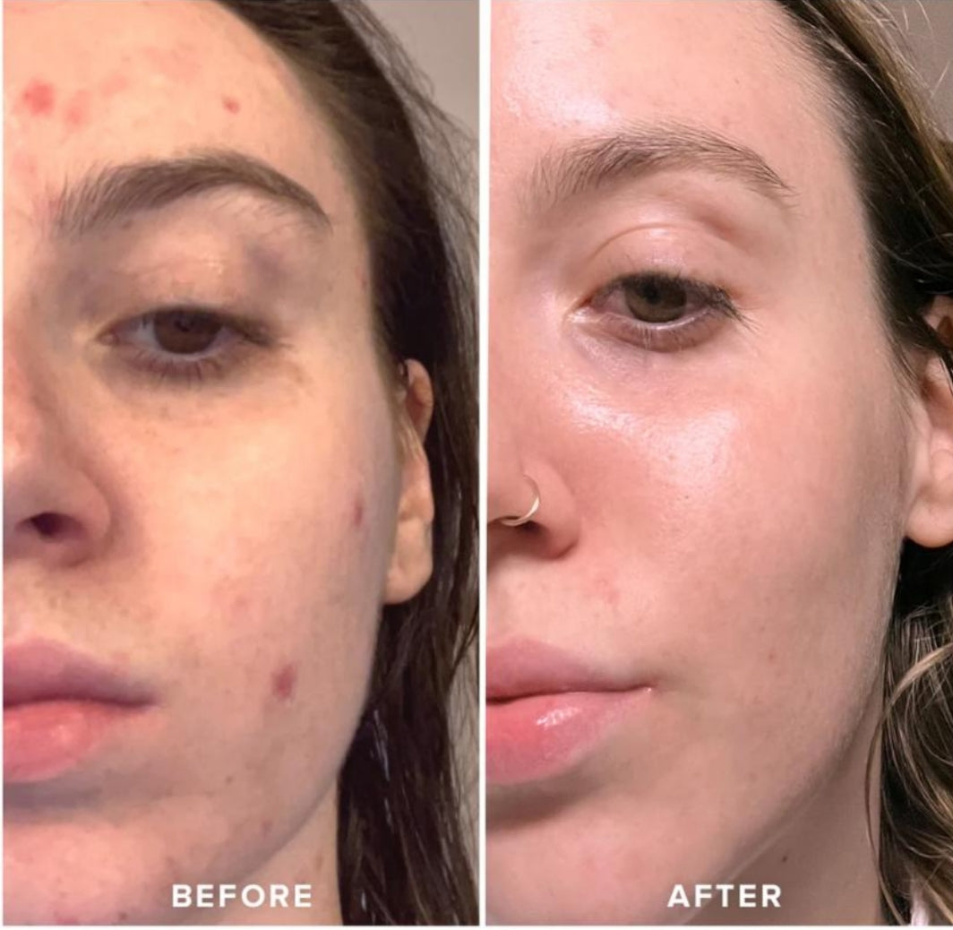 Ice Face Roller – Instantly Tighten Skin & Remove Puffiness